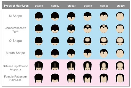 ریزش مو در مردان, علت ریزش مو, انواع ریزش مو