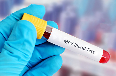 mpv پایین در آزمایش خون, آزمایش mpv چیست, آزمایش mpv