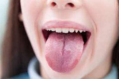درمان سوختگی زبان و گلو, سوختن زبان