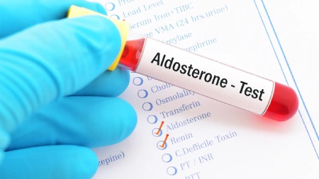 آزمایش آلدوسترون (ALD), درباره آزمایش آلدوسترون (ALD), نحوه انجام آزمایش آلدوسترون (ALD) 