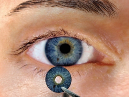 جراحی تغییر رنگ چشم, خطرات جراحی تغییر رنگ چشم