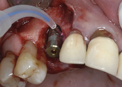  مضرات ايمپلنت دندان, مراقبت از ايمپلنت دندان