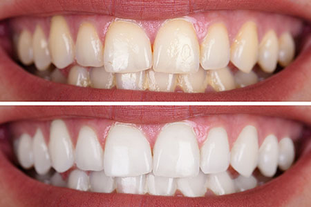 لاک سفید کننده دندان خانگی, لاک سفید کننده دندان فوری, لاک سفید کننده دندان