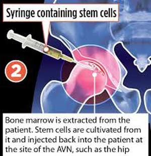 اخبار,اخبار علمی ,ترمیم مفصل استخوان ران اخبار,اخبار علمی ,ترمیم مفصل استخوان ران