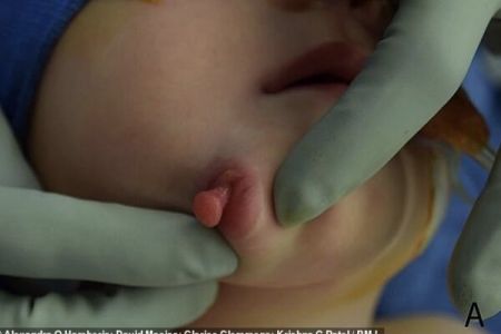 اخبارگوناگون,خبرهای گوناگون ,نوزادی با دو دهان اخبارگوناگون,خبرهای گوناگون ,نوزادی با دو دهان