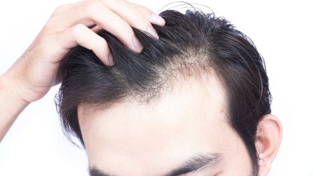 ریزش موی بدن مردان