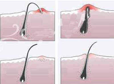 درمان موهای زیر پوستی