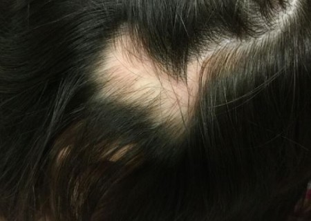 درمان ریزش منطقه ای مو