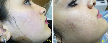 [عکس: conventional-method-acne-4.jpg]