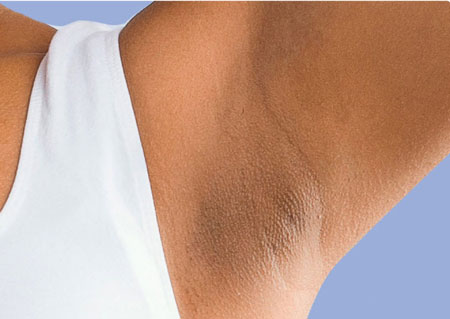 سیاهی زیر بغل, درمان سیاهی زیر بغل,مهمترین علت سیاهی پوست زیر بغل