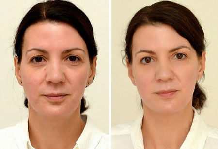 جوان شدن صورت, جوان سازی پوست,بهترین روش های جوانسازی پوست صورت