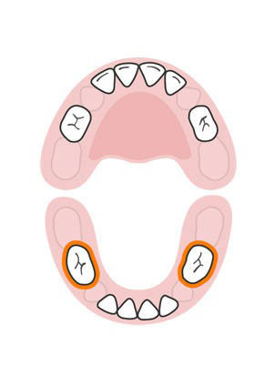 دندان های شیری کودک,دندان های پیشین فک بالا