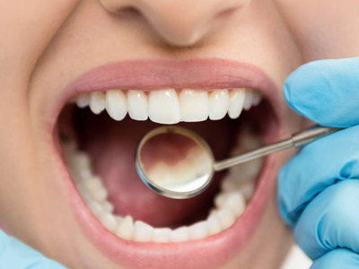 از بین بردن پلاک دندان به طور طبیعی, روشهای خانگی از بین بردن پلاک دندان