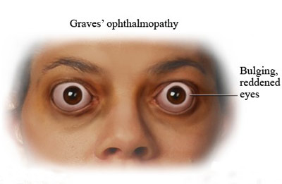درمان بیماری چشمی گریوز,درمان اصلی بیماری گریوز