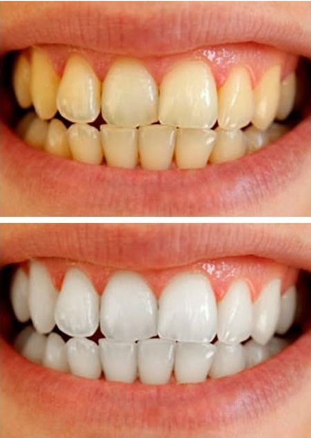 سفید شدن دندان , نکاتی برای سفیدی دندان
