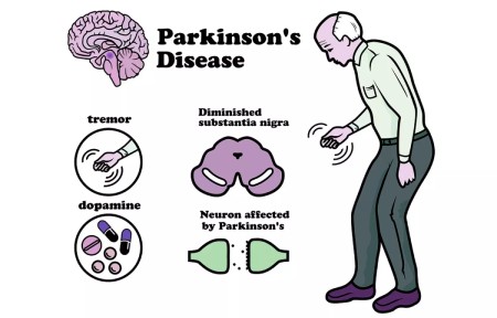 بیماری پارکینسون,بیماری پارکینسون چیست,عوارض بیماری پارکینسون