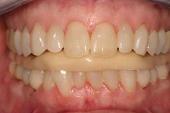 علل دندان قروچه, علائم دندان قروچه
