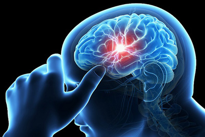 شناسایی علایم سکته مغزی,نشانه‌های سکته مغزی