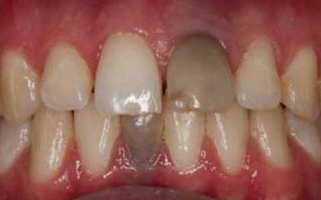 دلیل سیاه شدن دندان,رفع سیاهی دندان بزرگسالان