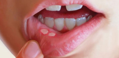راههای درمان آفت دهان,علت آفت دهان ودرمان آن