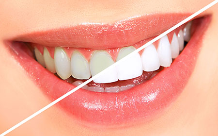 سفید کننده دندان,انواع سفید کننده دندان,سفید کننده های دندان,پودر سفید کننده دندان