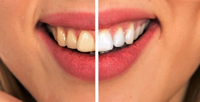روش درمان پوسیدگی دندان, موادی برای رفع پوسیدگی دندان