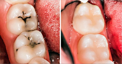 روش درمان پوسیدگی دندان, موادی برای رفع پوسیدگی دندان