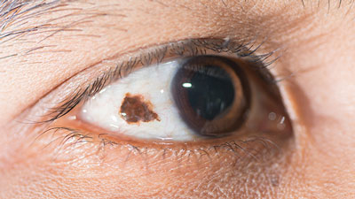 درمان سرطان چشم, تخلیه چشم