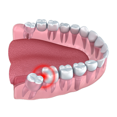  عصب کشی دندان عقل, مراحل جراحی دندان عقل
