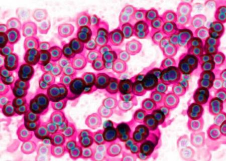 عفونت باکتریایی در ژاپن،اخبار پزشکی،خبرهای پزشکی