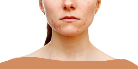 علل بیماری کندن پوست چیست و چگونه درمان می شود؟