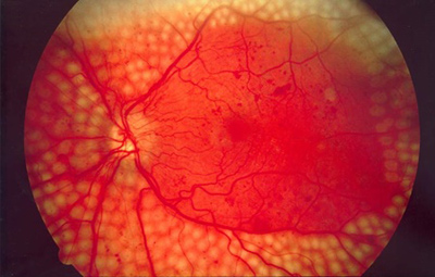 کشف چربی برای جلوگیری از بیماری چشم دیابتیک, بیماری چشم دیابتیک
