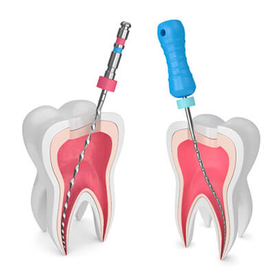 آشنایی با مراحل عصب کشی دندان,نحوه ی عصب کشی دندان